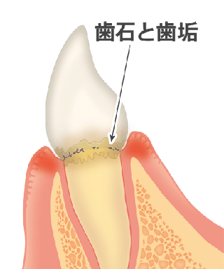 歯石の除去